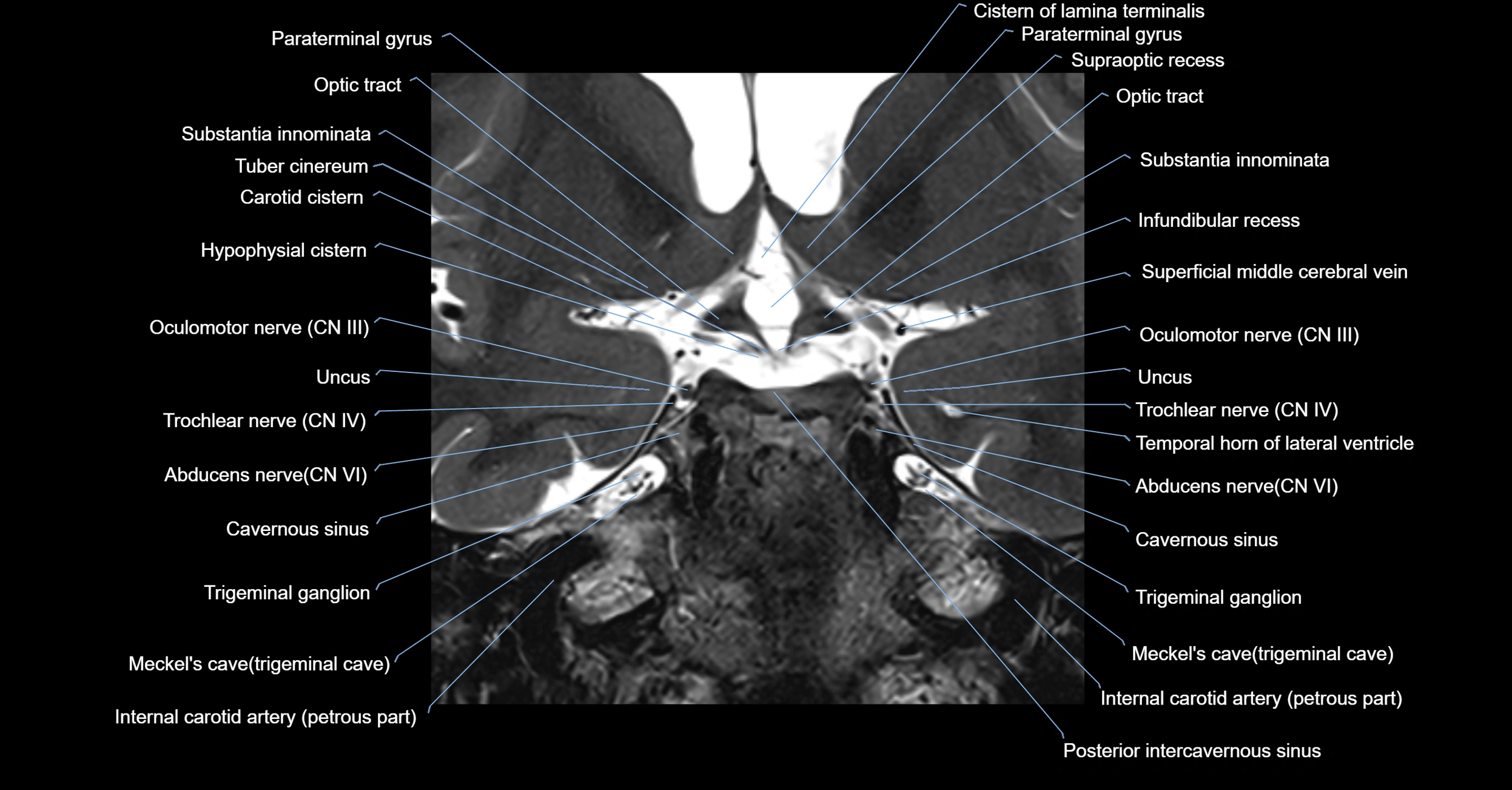 MRI cavernous sinus coronal cross sectional 3T anatomy image-img-00001-00014.webp